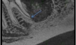 CT Dent