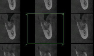 CT Dent