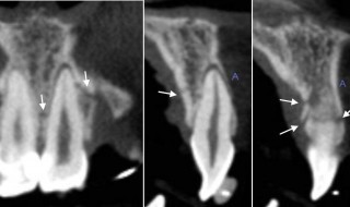 CT Dent