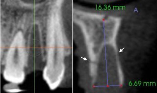 CT Dent