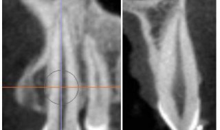 CT Dent