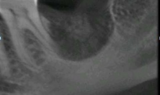 CT Dent