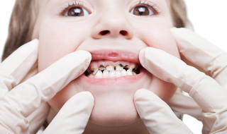 tooth decay