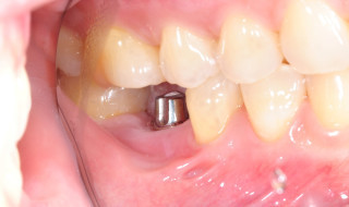 implants