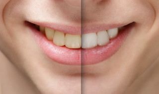 whitening