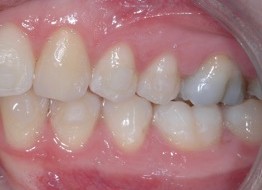 Figure 10: Left buccal occlusion after alignment