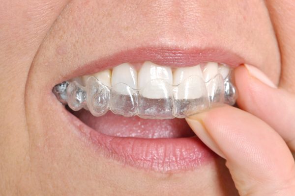 invisalign