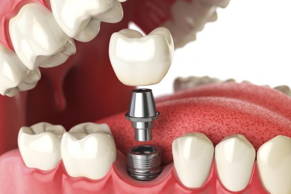 dental implants
