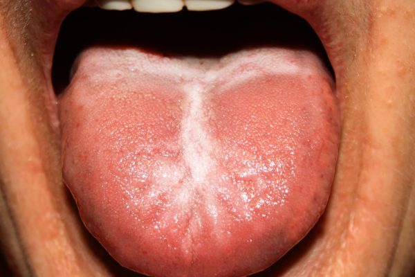 oral thrush