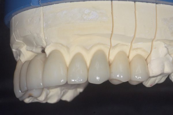E.max restoration side view