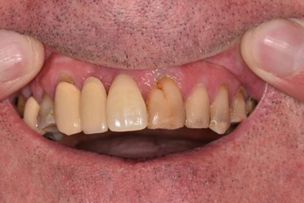 E.max preoperative presentation of the patient