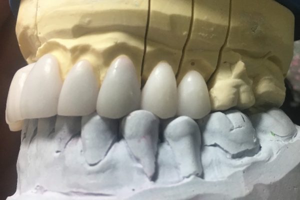 E.max preoperative diagnostic wax up