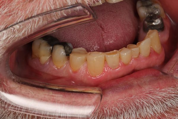 One Visit Crown clinical case