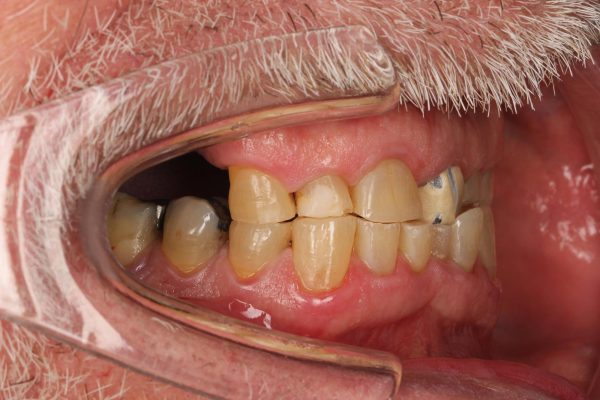 One Visit Crown clinical case