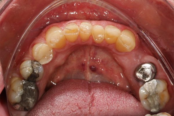One Visit Crown clinical case