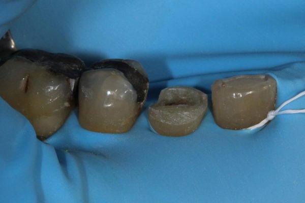 One visit crown clinical case