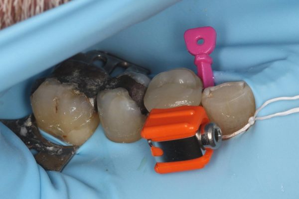 One Visit Crown clinical case