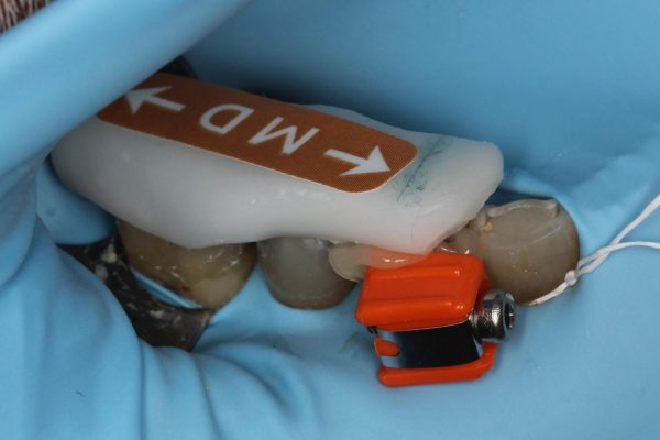 One Visit Crown clinical case