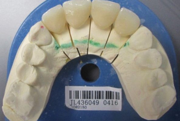 ultra-translucent zirconia