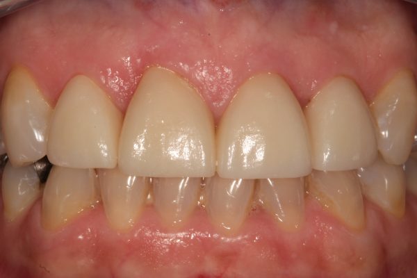 ultra-translucent zirconia