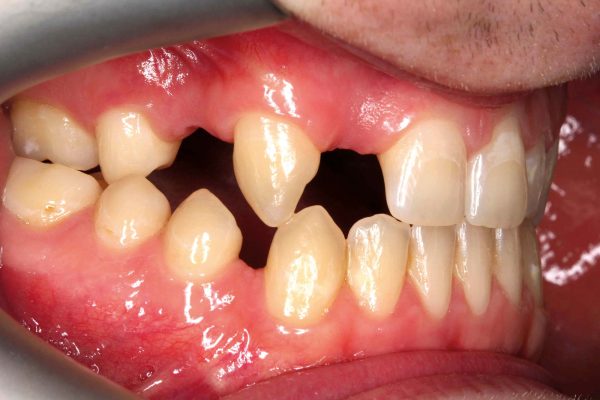 implant placement