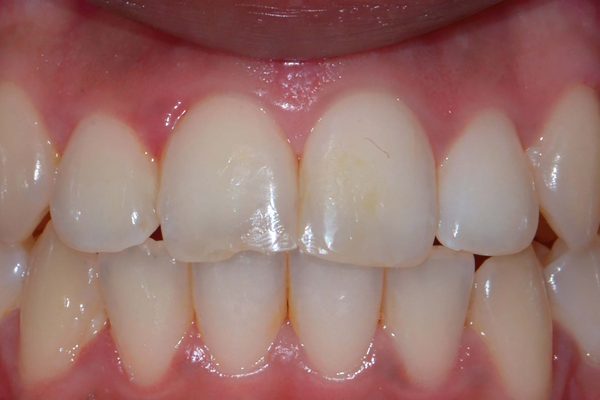 Minimally invasive
