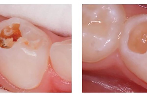Atraumatic Restorative Treatment can be preferable in order to avoid the spread of virus particles (aerosol generation)