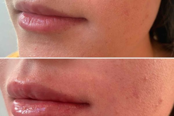 Lip fillers