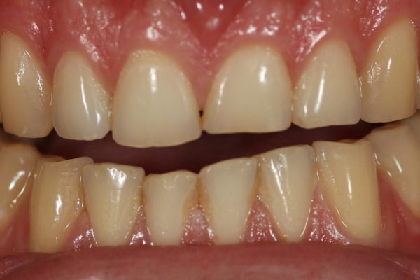 toothwear due to bruxism
