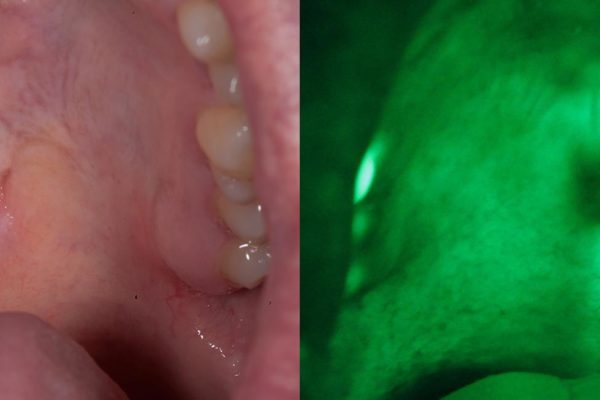 mouth cancer detection