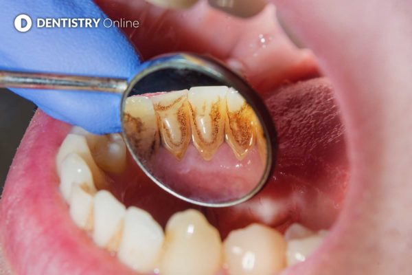 Eight in 10 at increased risk of caries since pandemic, research shows