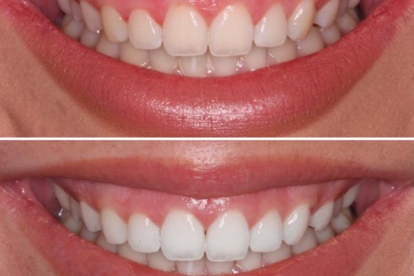 gummy smiles
