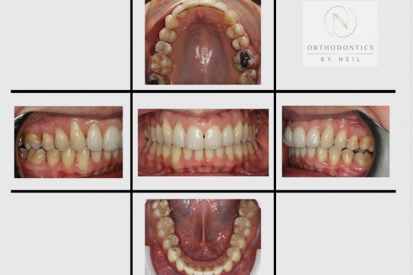 Invisalign