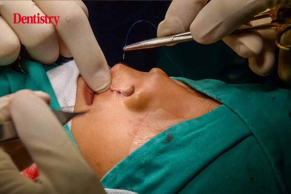 Operation Smile discuss cleft lip conditions