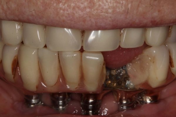 Figure-2-implant