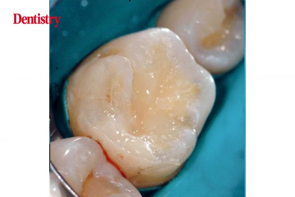Biodentine-4