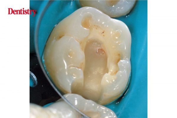 Biodentine-5