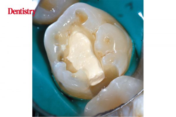 Biodentine-6