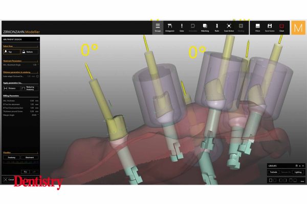 Raw-Abutments-3