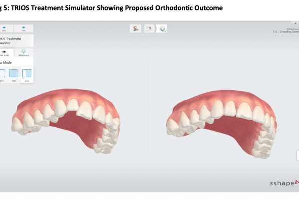 intraoral scanner