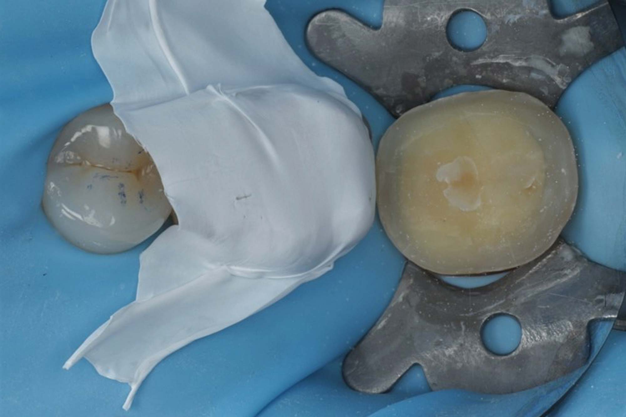 Lower-molar-figure-10