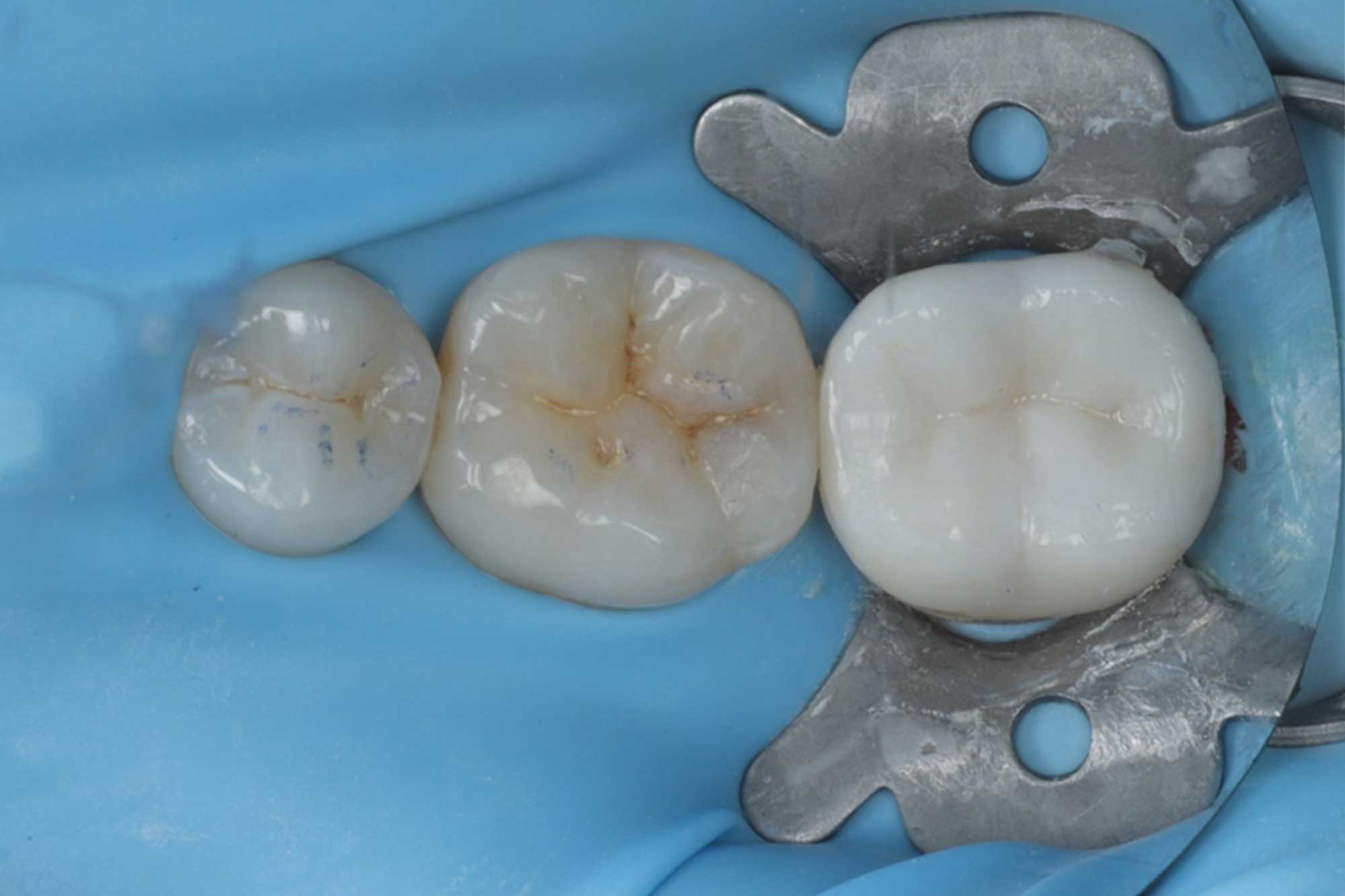 Lower-molar-figure-11