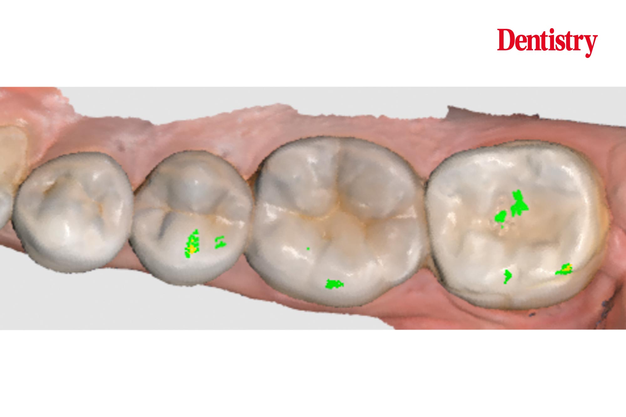 Lower-molar-figure-2