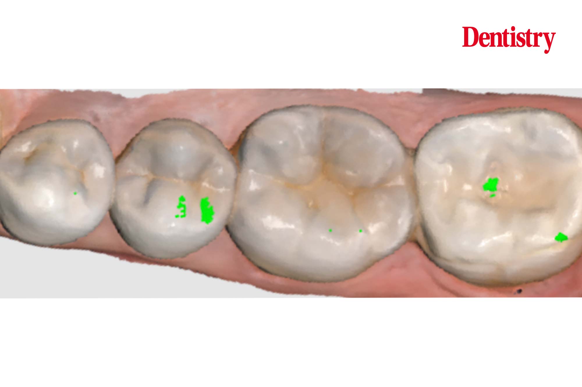 Lower-molar-figure-3