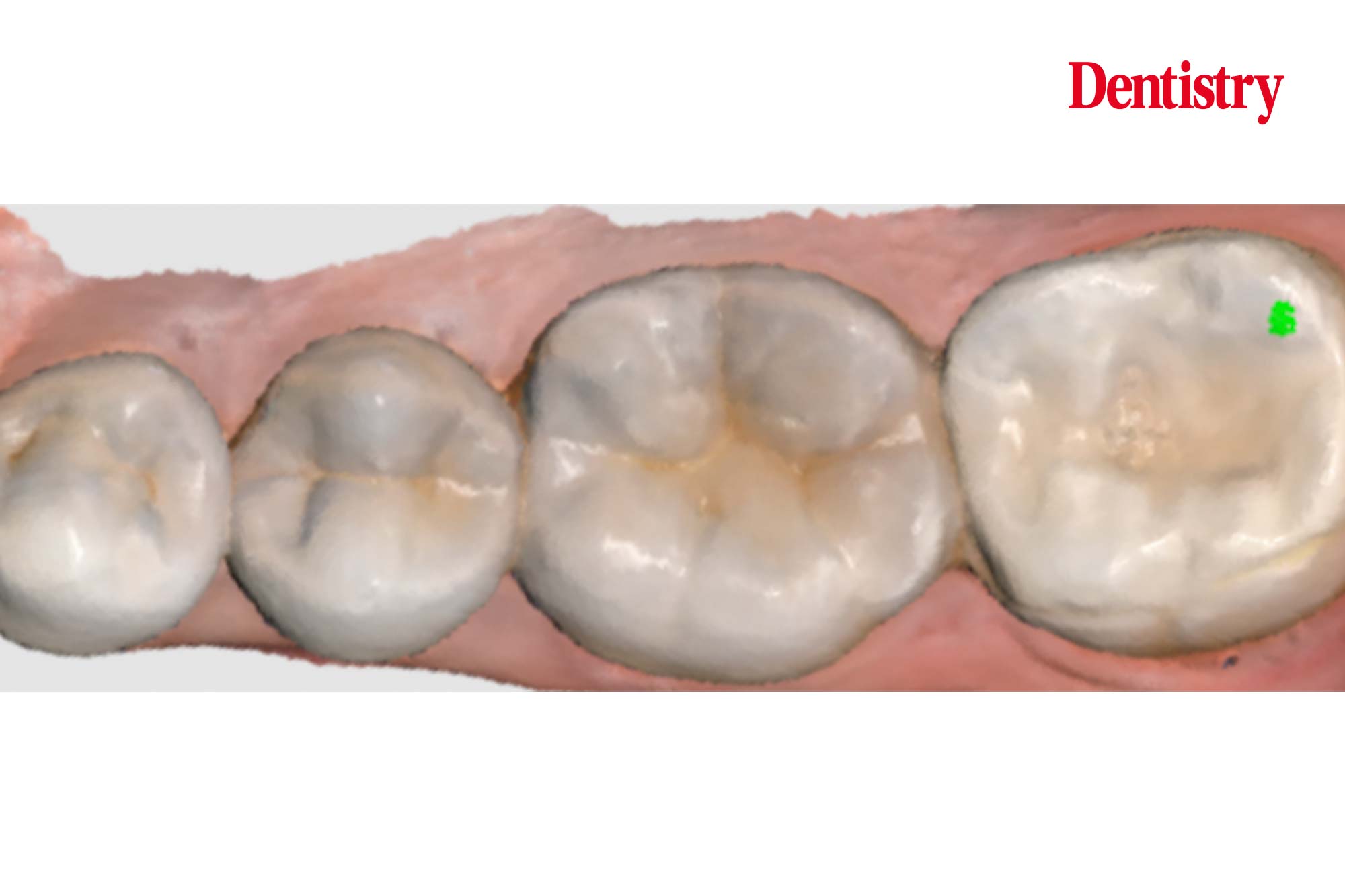 Lower-molar-figure-4