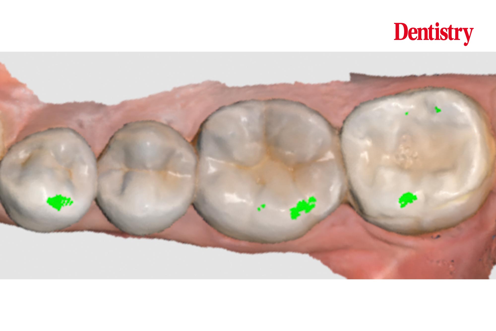 Lower-molar-figure-5