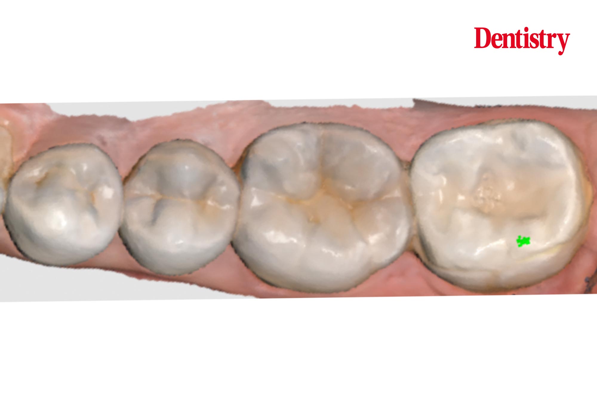 Lower-molar-figure-6