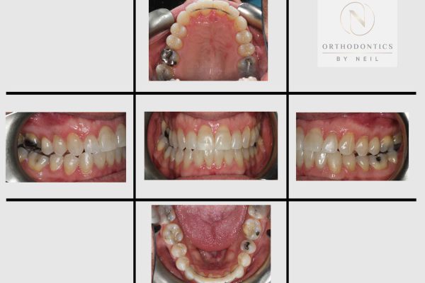 Invisalign