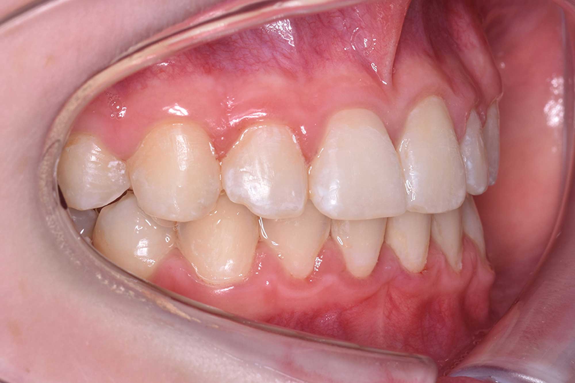 Fig-12-Right-Buccal---after