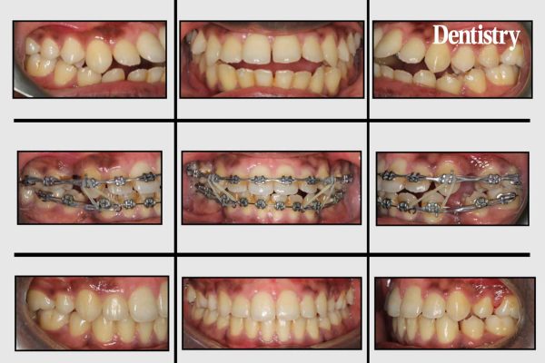 anterior open bite